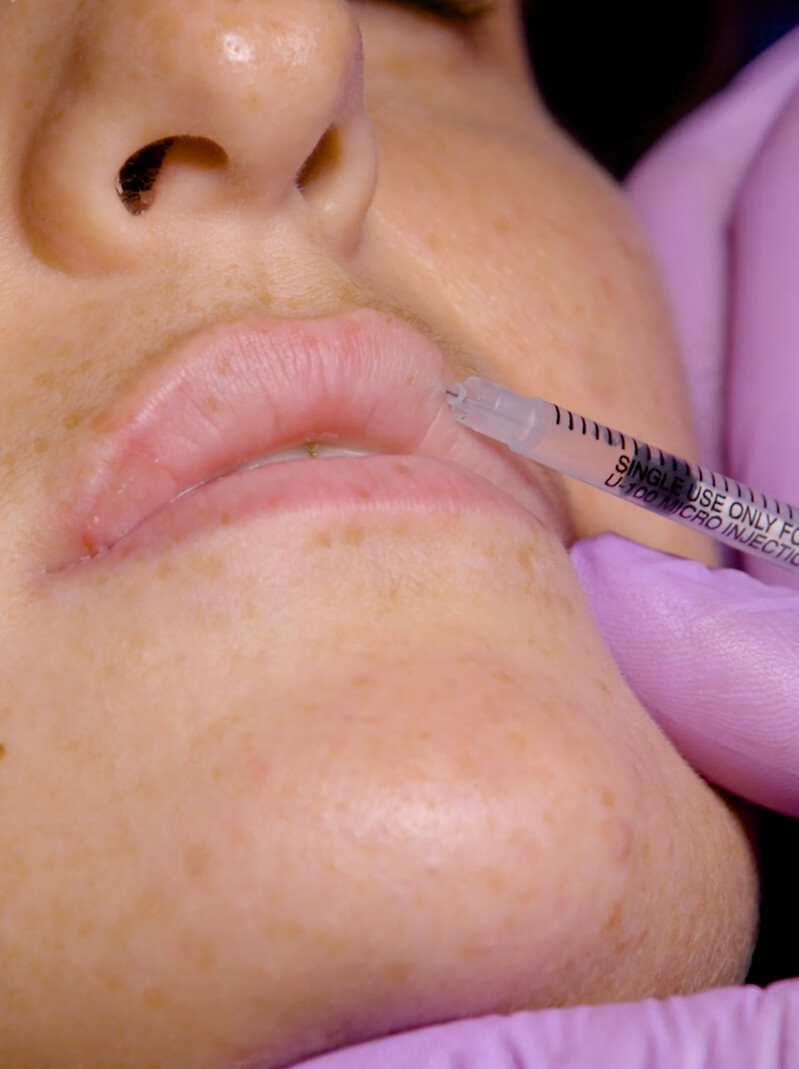 Foundation Dermal Fillers Training (1)