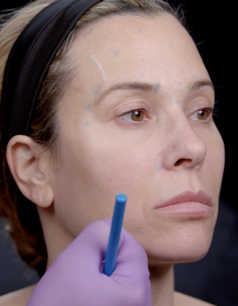 Full Face Botox Training Marking up