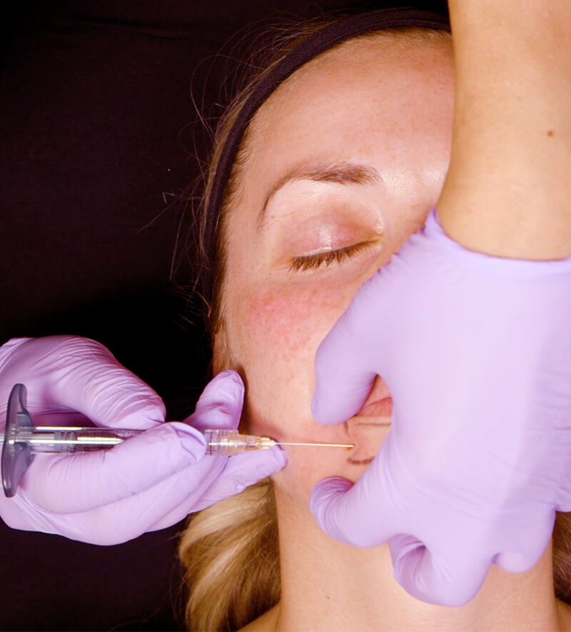 Lower Face Filler Training London Image