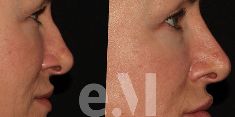 nose job filler training london 799x400